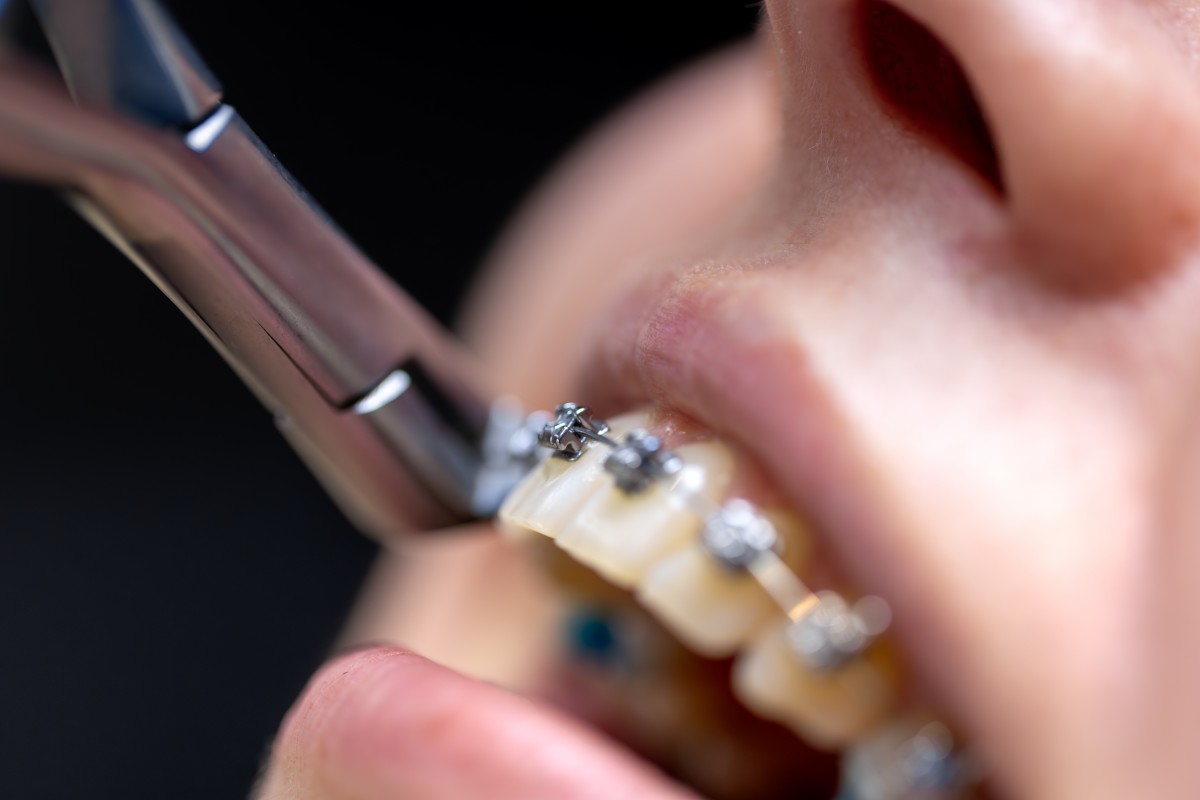 dental-procedure-installing-braces-close-up-dentistry-braces-teeth