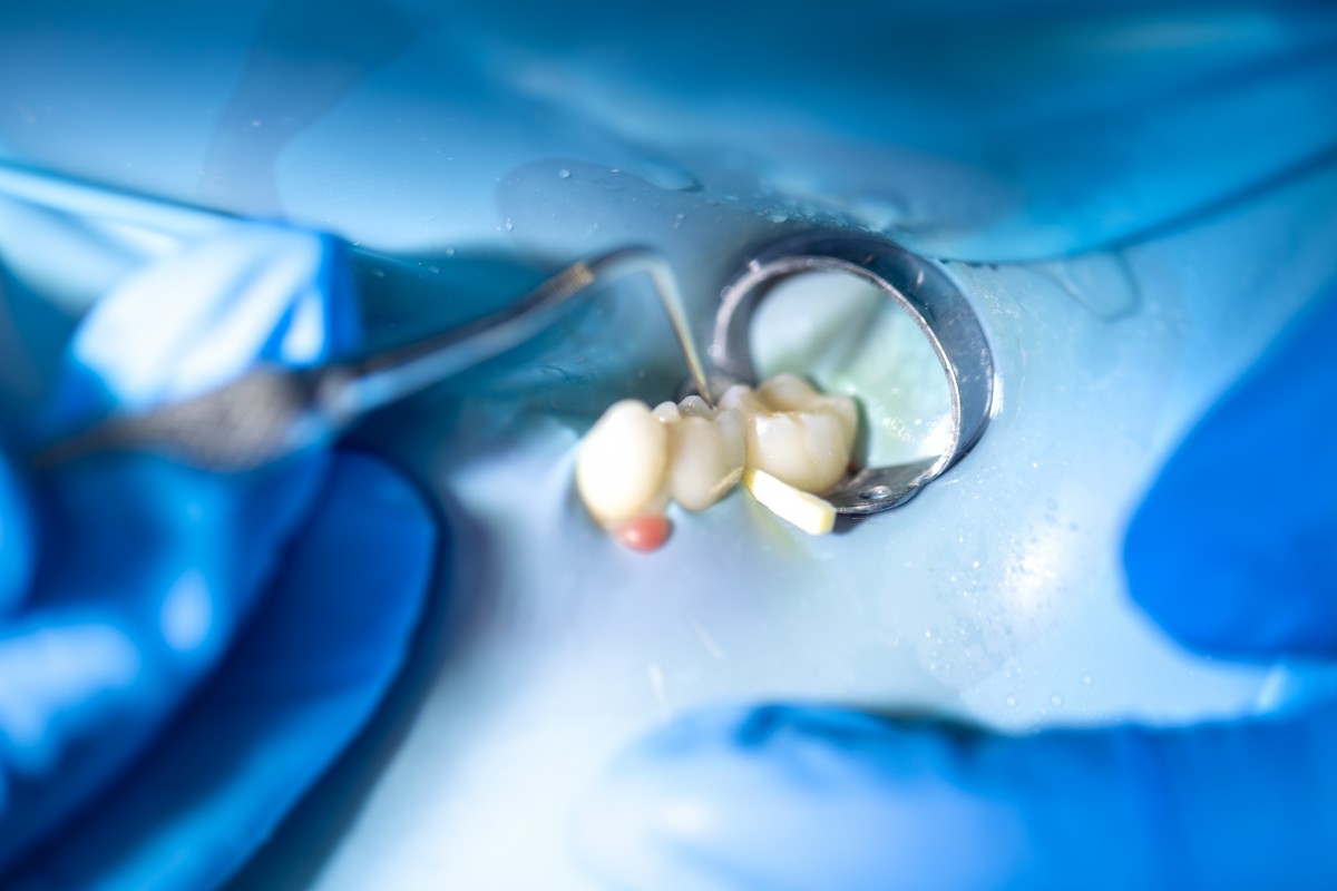 dentist-treats-childs-tooth-using-rubber-dam-closeup-tooth-treatment